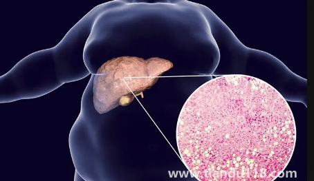 肝代謝不好吃什么調(diào)理(肝代謝不好有什么癥狀)(圖3) 肝代謝不好吃什么調(diào)理3
