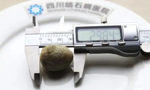 腎結(jié)石3mm需要吃藥嗎2