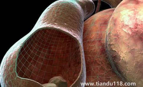 腎結(jié)石三毫米可以碎嗎3