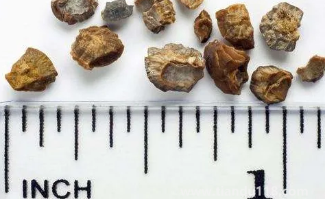 腎結石3mm需要治療嗎2