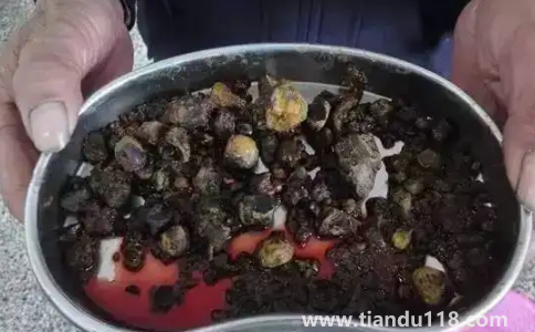 腎結石3mm×3mm多大3