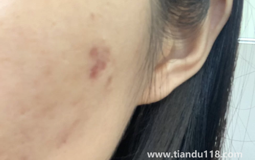 好幾年的痘印還發(fā)紅還能好嗎1