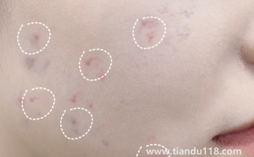 好幾年的痘印還發(fā)紅還能好嗎3